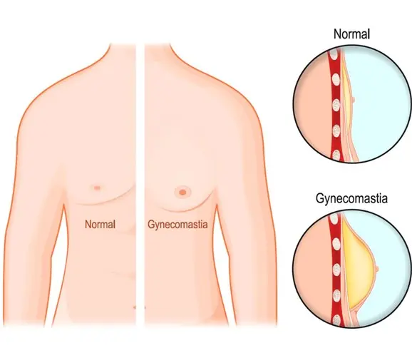 الغذاء وأثره على التثدي لدى الرجال - العلوم الحقيقية