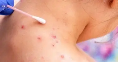 بعد ظهور حالات جدري مائي في مدرسة بالمنوفية.. كيف تحمي نفسك وأطفالك؟