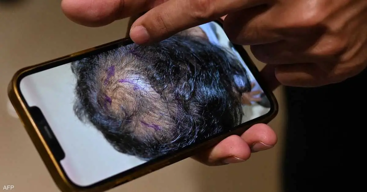 ابتكار مصل لعلاج تساقط الشعر في قرابة 20 يوما