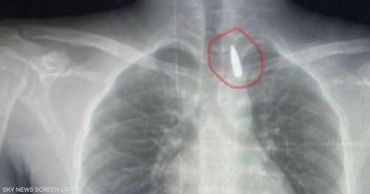 مقذوف استقر في صدره.. إنقاذ حياة مصاب من غزة في مصر