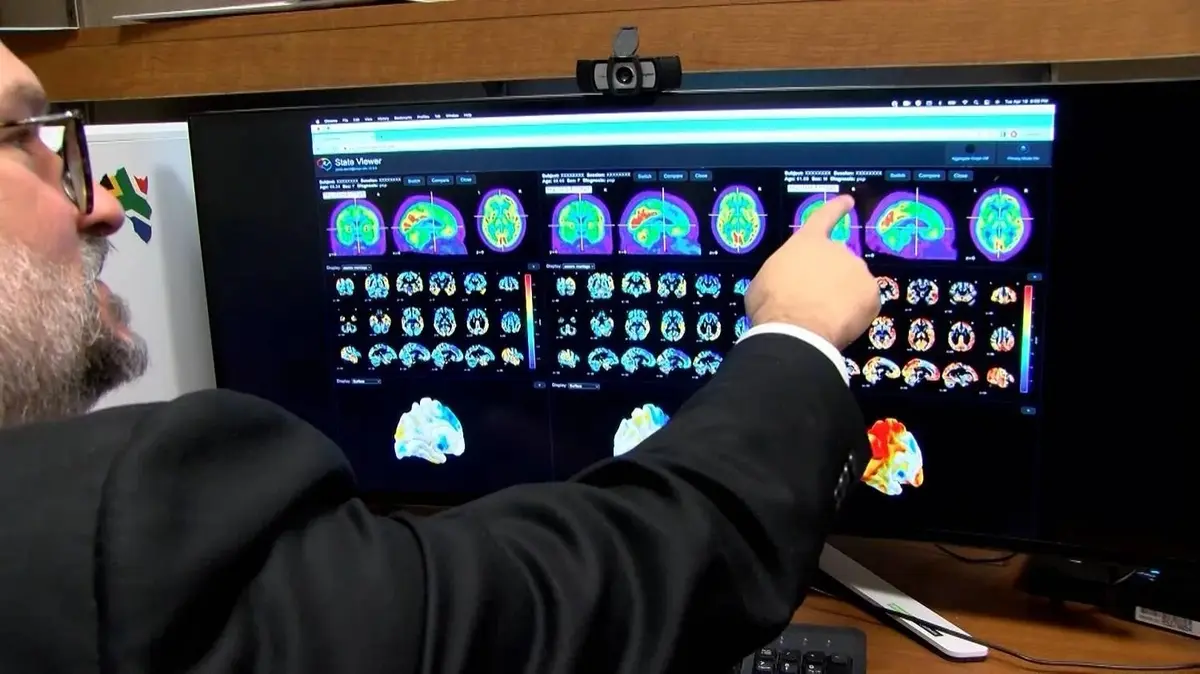 أداة تقنية جديدة تتوقع خطر ألزهايمر قبل ظهور الأعراض