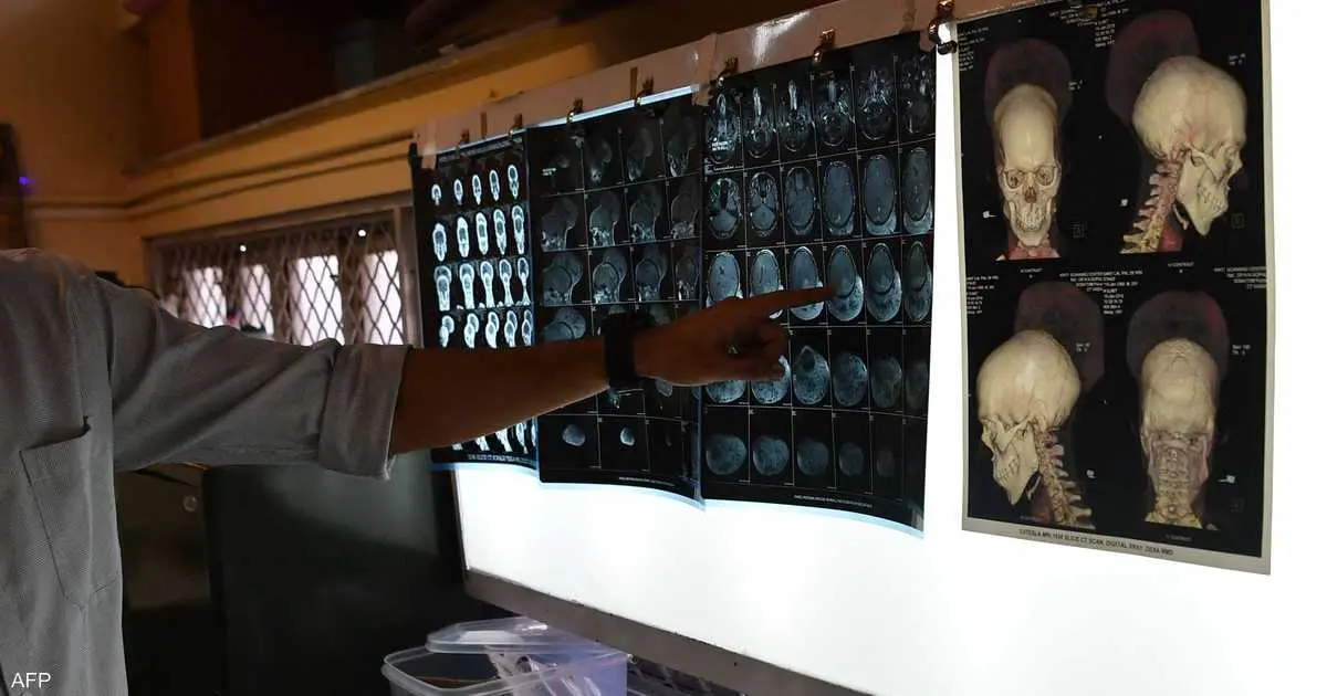 دراسات تكشف علاقة "مقلقة" بين الاكتئاب والصرع