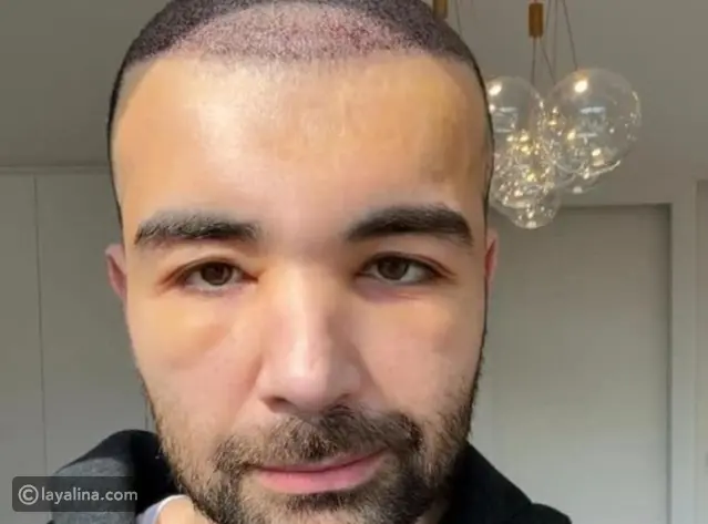 عقيل الرئيسي يوضح سبب تغير ملامحه بعد زراعة الشعر