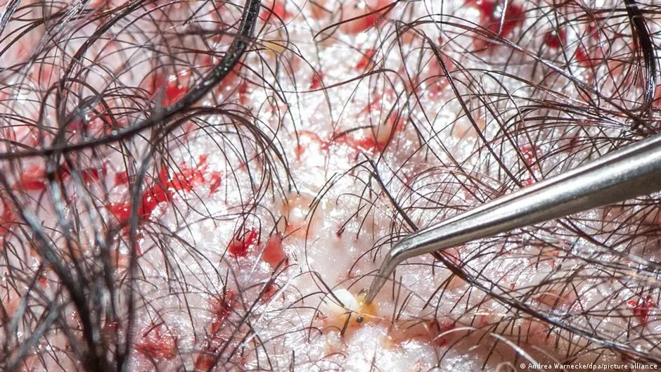 لماذا لا تكلل عمليات زراعة الشعر عند النساء غالباً بالنجاح؟ – DW – 2025/12/23