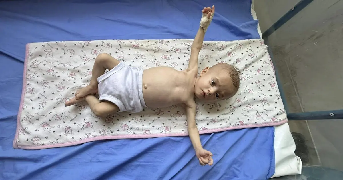 الجوع مستمر بصمت.. سوء التغذية يطارد أطفال غزة بعد الحرب