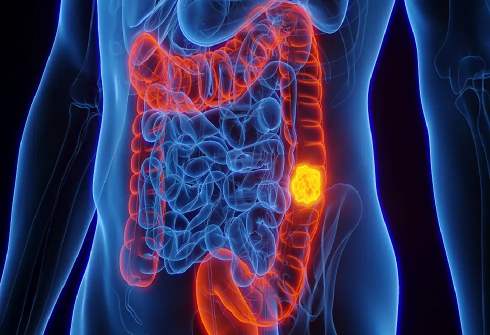 صلابة القولون ودورها في تطور السرطان