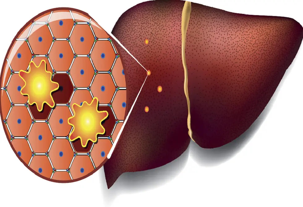 النظام الغذائي الغني بالدهون قد يهيئ الكبد للإصابة بالسرطان