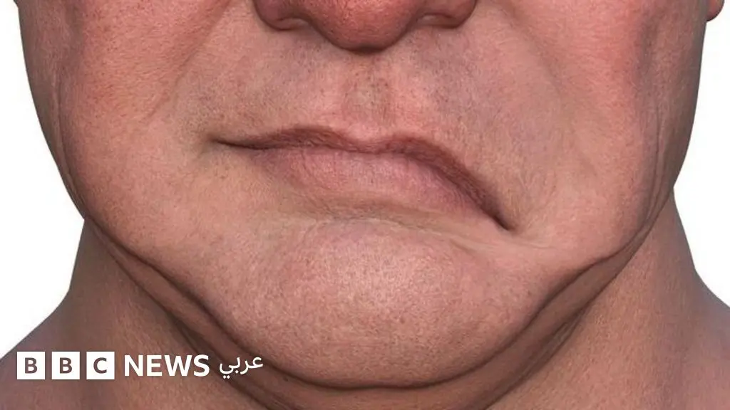 ما هو التهاب العصب السابع وما هي طرق علاجه؟ - BBC News عربي