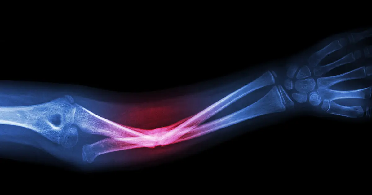 كسور مفاجئة قد تكون أول مؤشر لهشاشة العظام