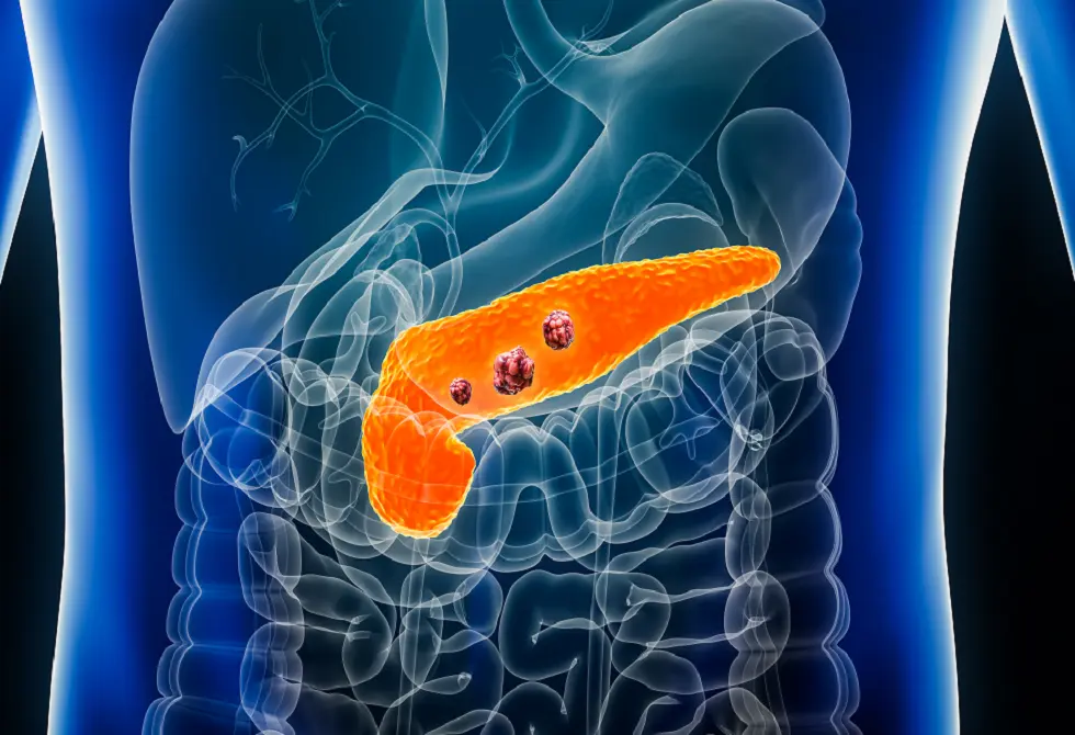 فحص دم جديد قد ينقذ آلاف الأرواح من سرطان البنكرياس