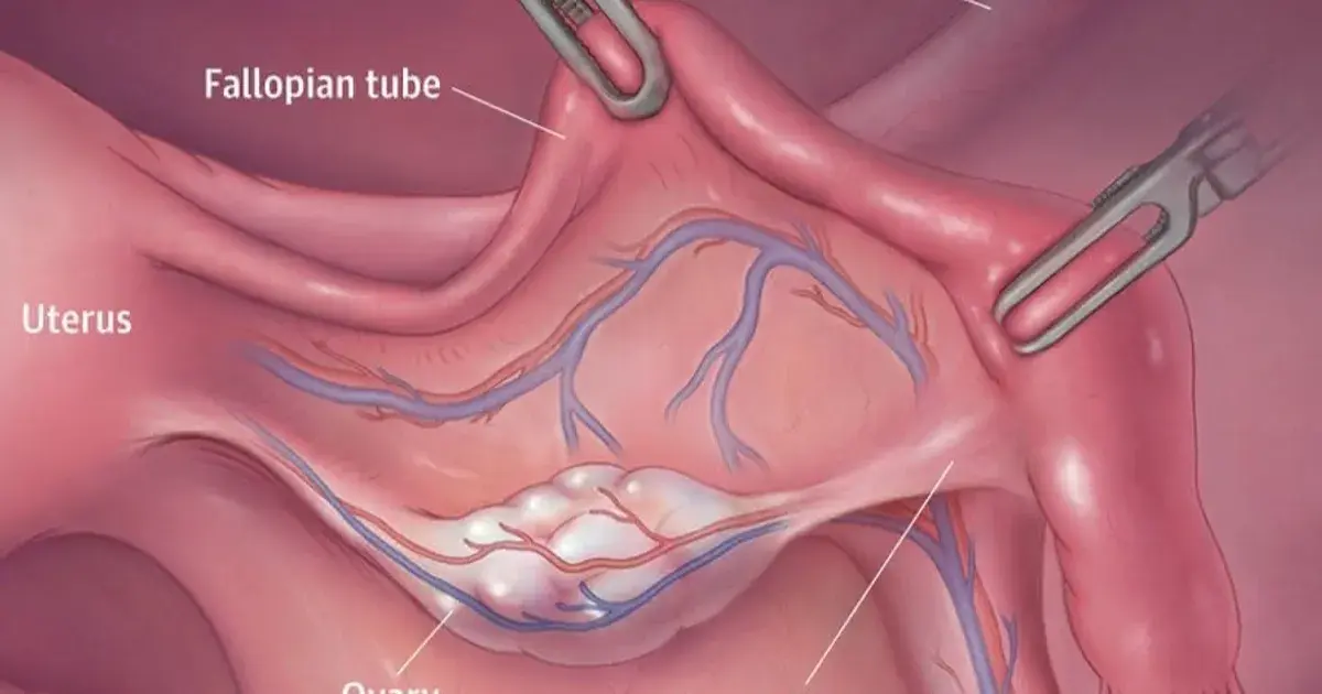 دراسة: الاستئصال الوقائي لقناة فالوب يقلل خطر الإصابة بسرطان المبيض