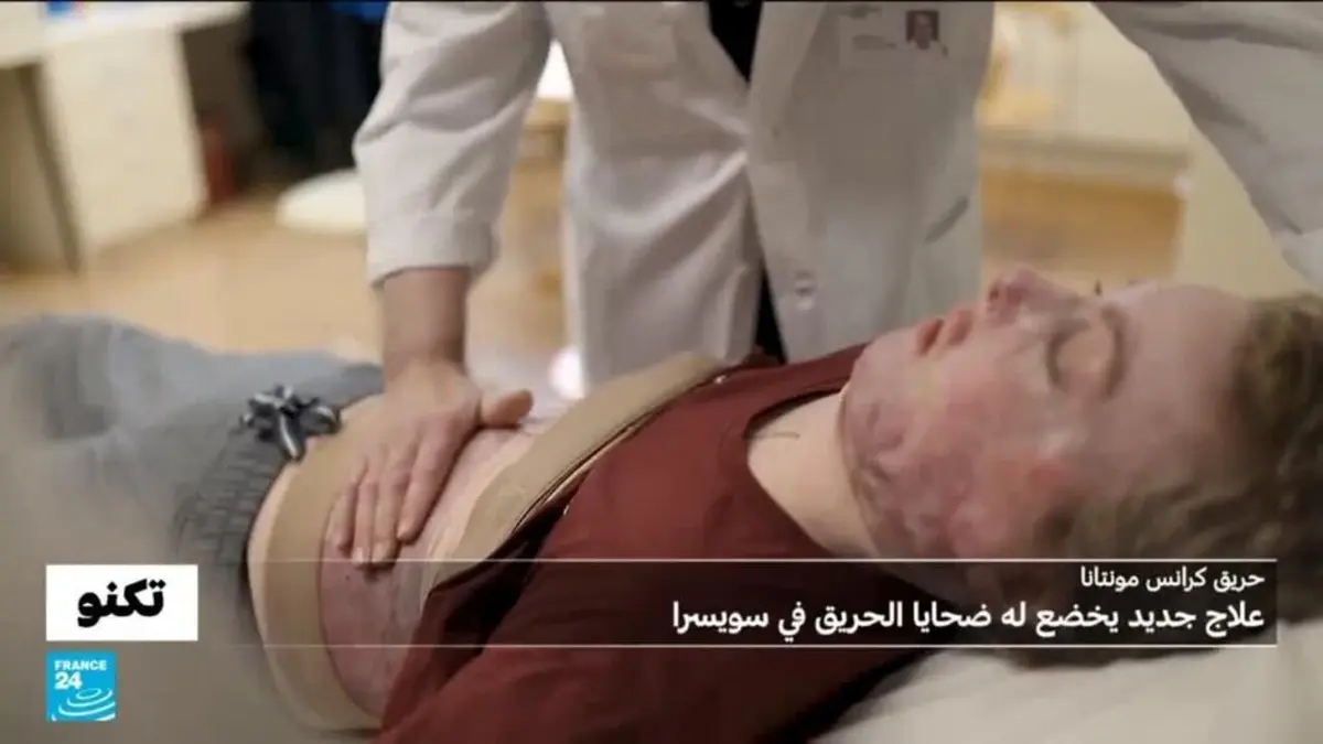 تكنو - المصابون بحروق الدرجة الثالثة في حريق كرانس مونتانا بسويسرا يخضعون لعلاج جديد لا يترك آثار الحروق
