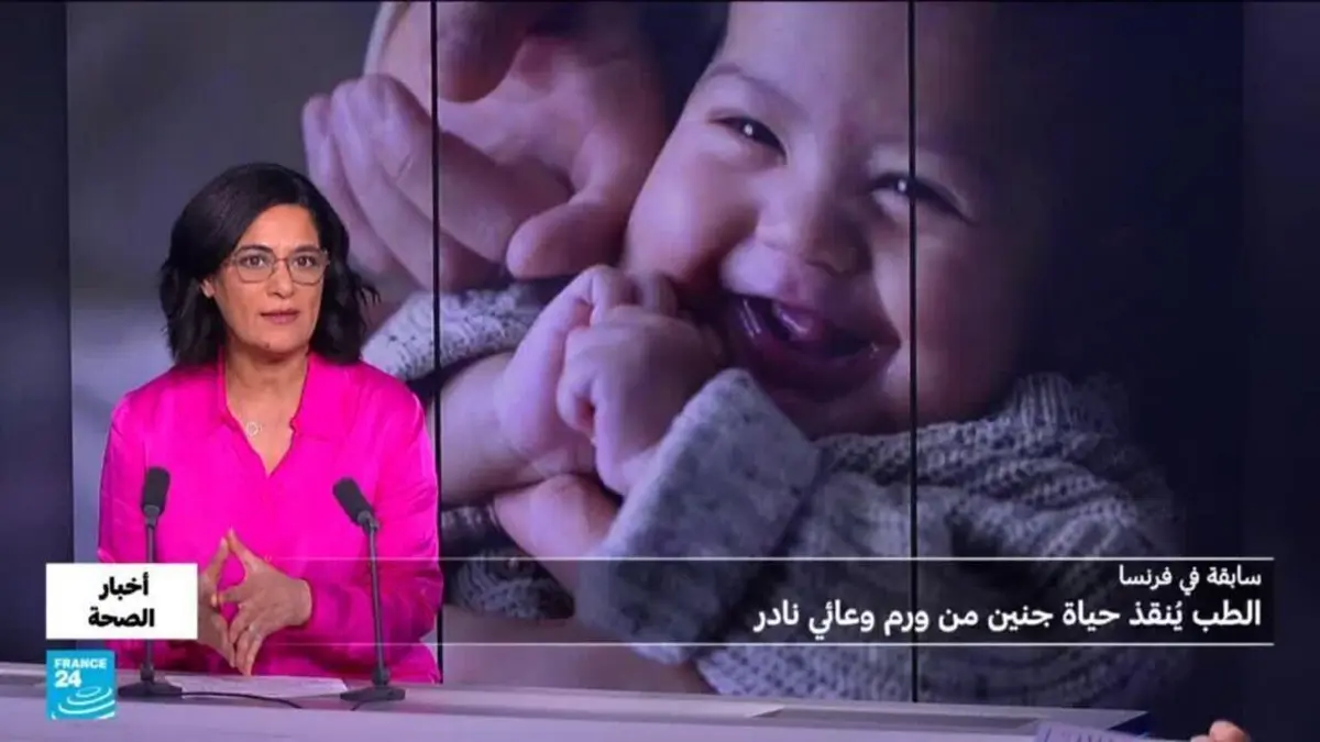 أخبار الصحة - سابقة عالمية.. علاج جنيني ينقذ طفلا من ورم وعائي