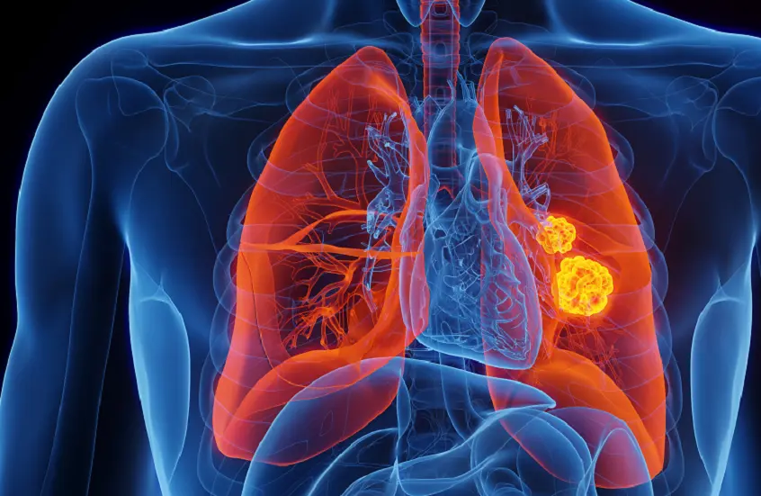 اكتشاف طريقة لتعزيز فعالية علاج سرطان الرئة