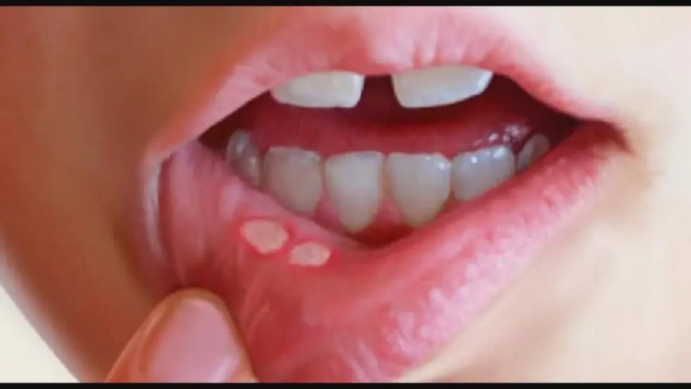 الأعراض المبكرة لسرطان الفم.. تعرف عليها قبل أن تتطور