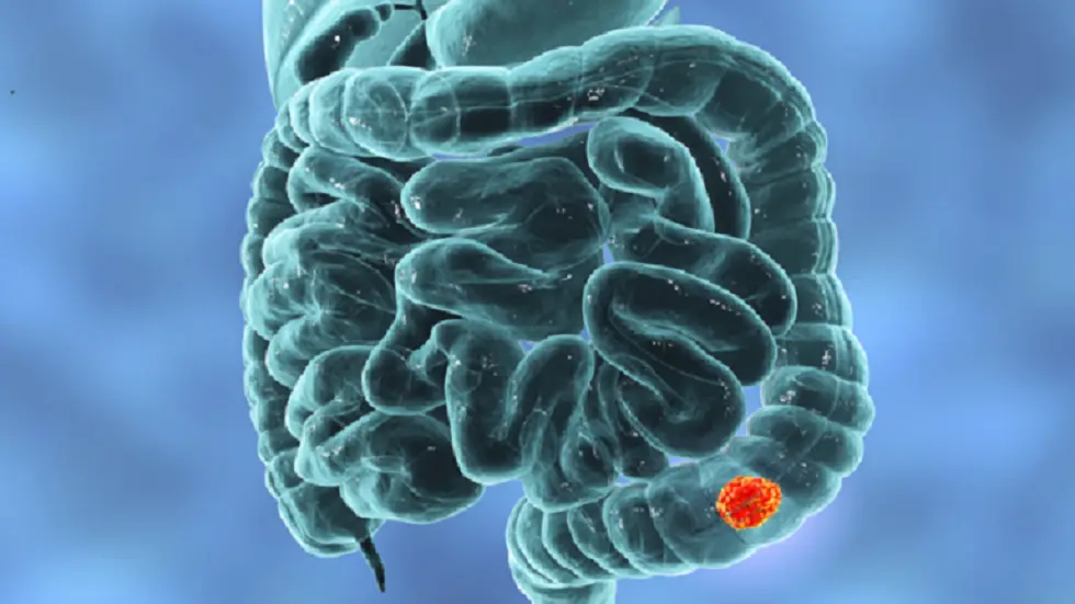 سبب رئيسي للإصابة بسرطان القولون