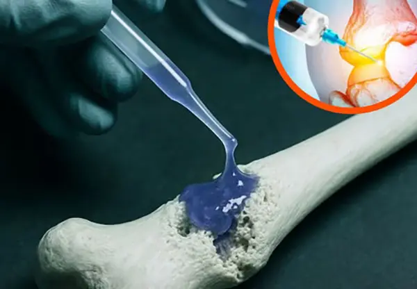 ابتكار مادة هلامية تحاكي بنية العظام وتعزز التئام الكسور