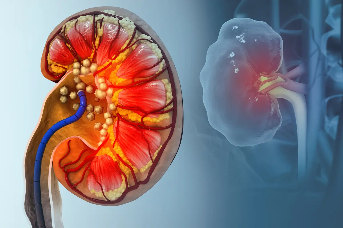 دراسة أمريكية تكشف دور البكتيريا في تكوّن حصوات الكلى