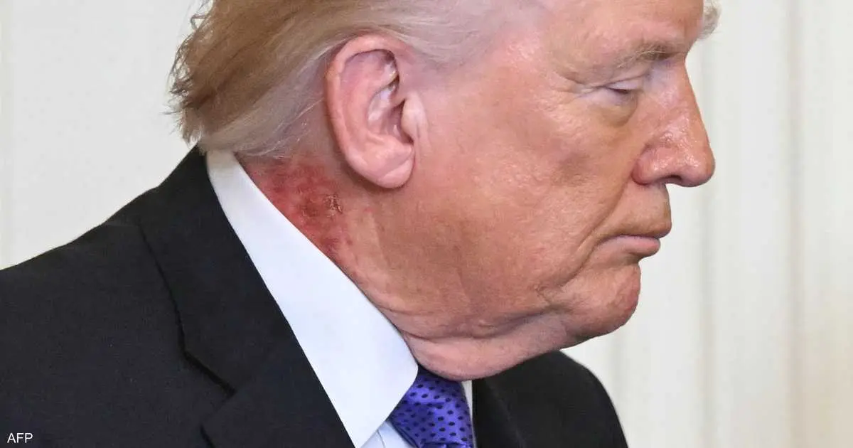 طبيب ترامب: الرئيس يستخدم علاجا وقائيا لطفح جلدي في رقبته