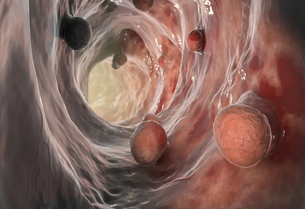 مشروبات شائعة الاستهلاك تضاعف خطر الإصابة بسرطان الأمعاء