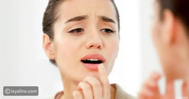 علاج متلازمة الفم الحارق