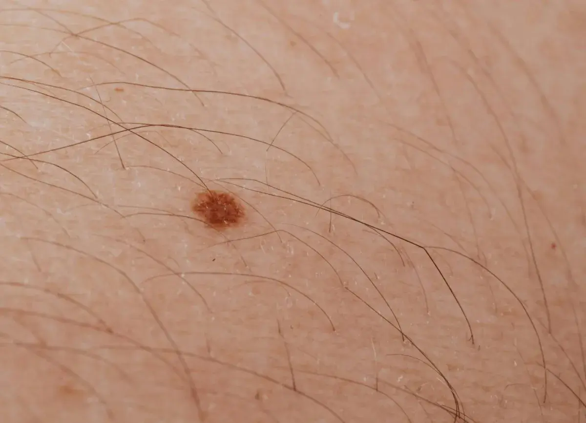 دراسة أسترالية تتوقع انخفاض معدل الإصابة بسرطان الجلد بين الأطفال