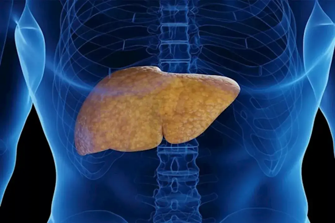 دراسة: فيتامين ب 3 قد يشكل علاجاً واعداً للكبد الدهني